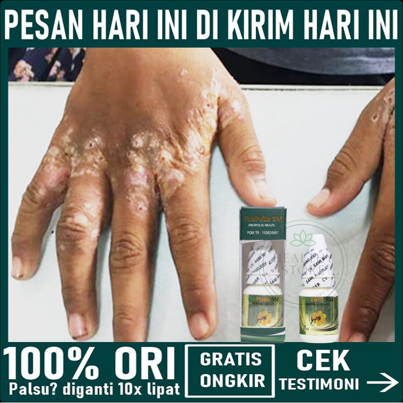 SALEP BUDUG BERNANAH, OBAT BUDUG DAN GATAL, OBAT SCABIES MANUSIA, OBAT SCABIES / KUDIS, SALEP SCABIE