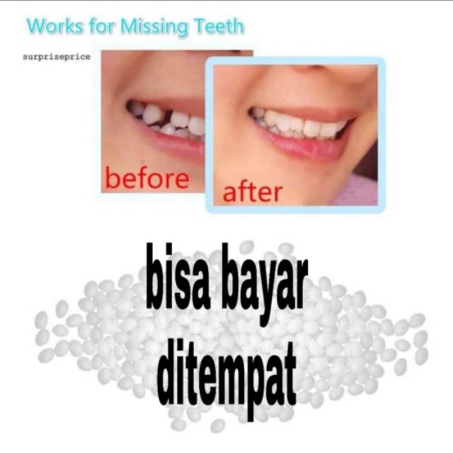 Gigi palsu sementara penambal gigi patah renggang dll temporary tooth temptooth gingsul patah