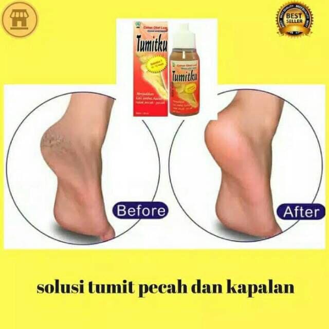 Tumitku Obat Ampuh Mengatasi Kaki Pecah Kapalan / Menghilangkan kaki kapalan BPOM