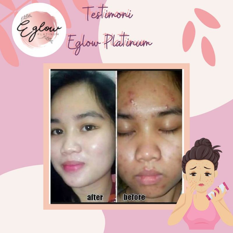 PAKET EGLOW PLATINUM KEMASAN TERBARU ORIGINAL 100% RESMI / Whitening series / Acne series / Menghaluskan Wajah / Kinclong