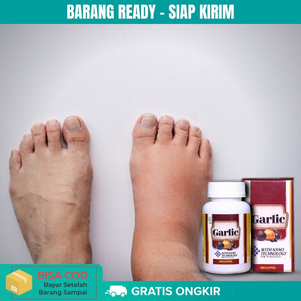 Obat Kaki Bengkak Diabetes, Obat Kaki Bengkak Asam Urat, Obat Kaki Bengkak Jantung, Obat Kaki Bengka