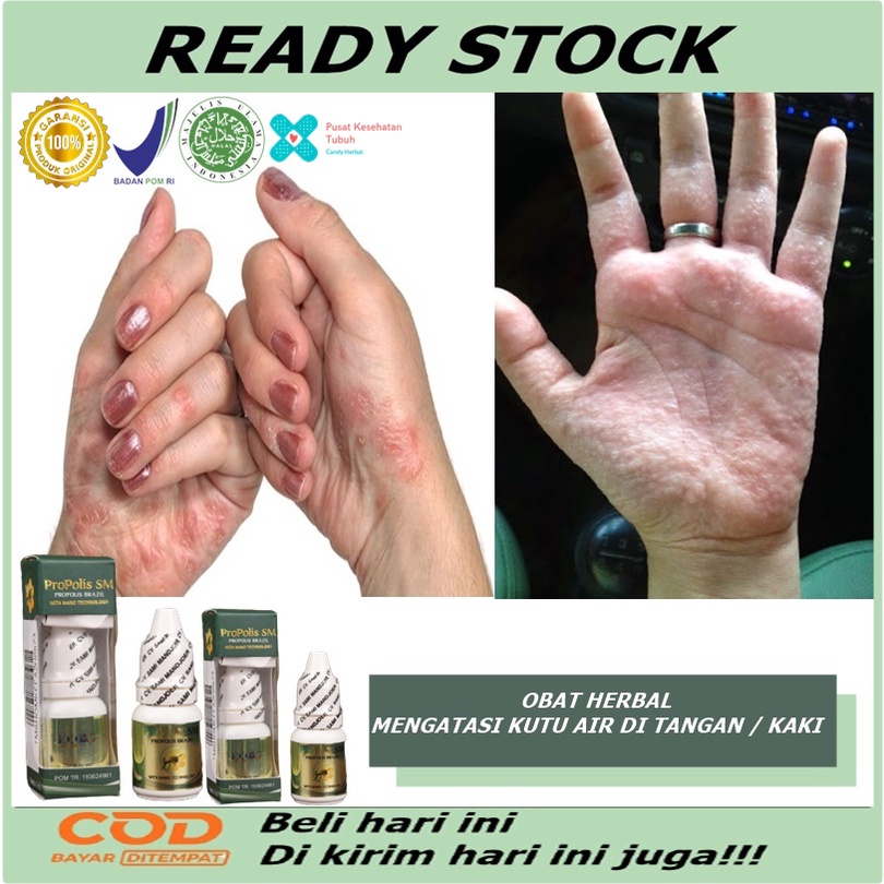 Obat kutu air, Obat kutu air tangan, Obat kutu air untuk kaki, Obat penghilang kutu air, Salep kutu 