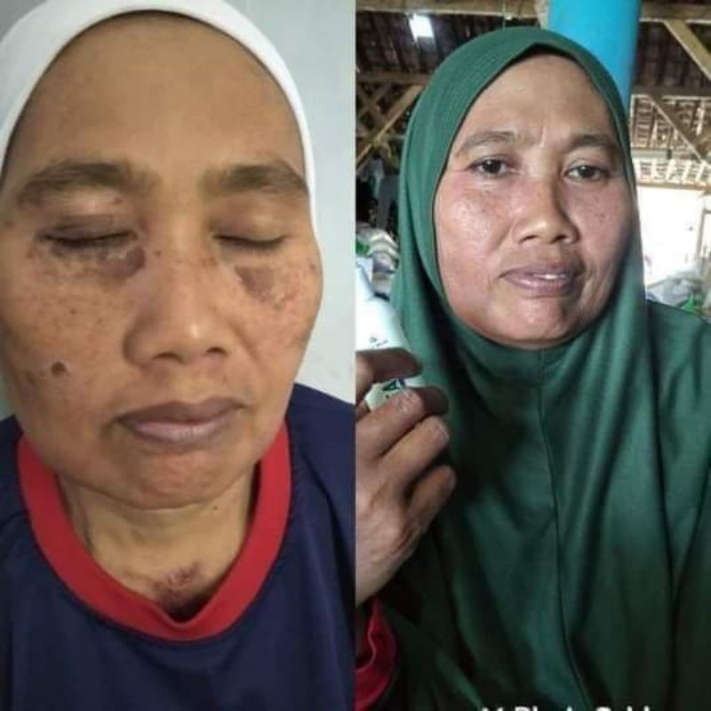 NBS- MENGOBATI FLEK HITAM - Natura Beauty Spray (Serum Multifungsi) 100% Original