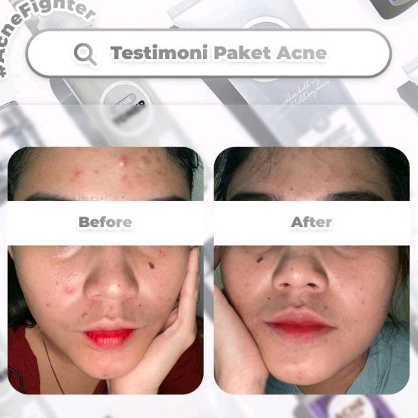 BENINGS CLINIC SKINCARE DOCTOR OKY PRATAMA PAKET ACNE | BENING SKINCARE | BENINGS CLINIC