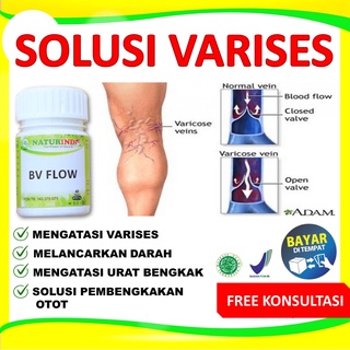 Jual Obat Varises Di Kaki Dan Betis Paling Ampuh Obat Varikokel Obat Parises Obat Varises Paling