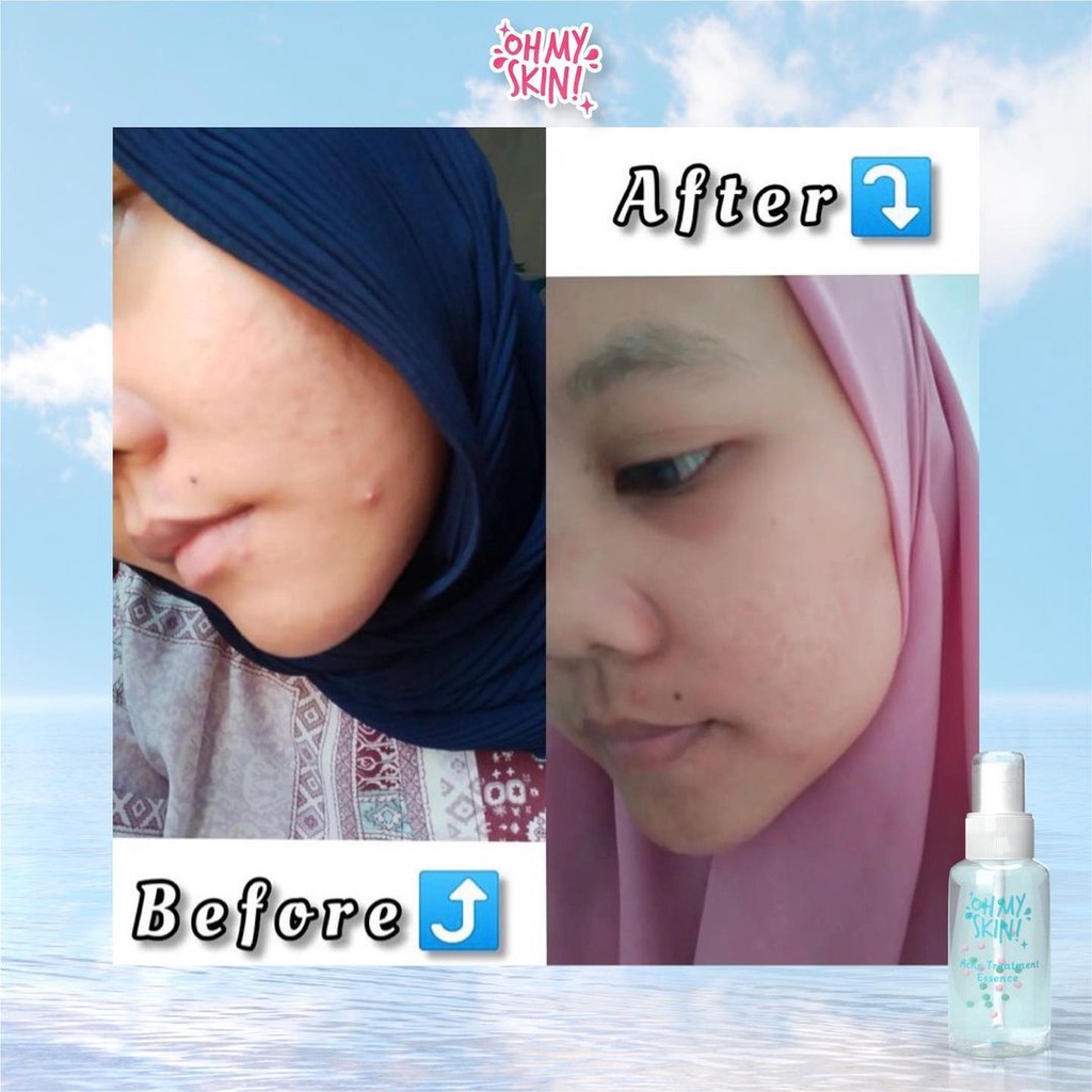 ESSENCE LIGHTENING GLOW &amp; ACNE REAPAIRING ESSENCE OhMySkin [DIST RESMI] Essence Wajah 60ml