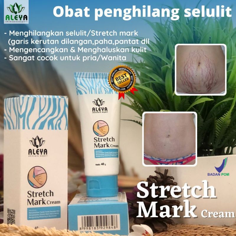 Stretch Mark Aleya Menghilangkan Stretch Mark,Selulit,Bekas Operasi,Bekas Luka