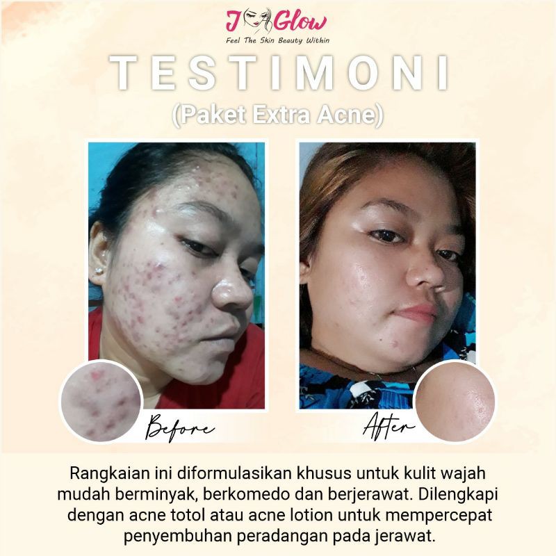 Jglow Skincare Paket Acne Sulfur Whitening Cream Skin glowing Perawatan Wajah Jerawat Meradang Bpom-7