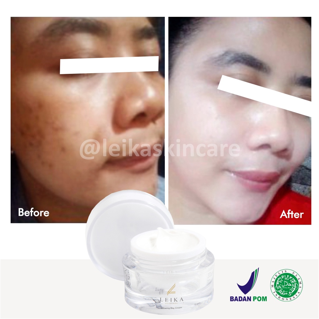 Krim Wajah Penghilang Bekas Luka Jerawat Asli 100% Ampuh! Penghilang Bekas Jerawat Bopeng Cepat BPOM Halal MUI Penghilang Bekas Jerawat Menghitam Glowing Day Cream Leika Skincare 10gr Original