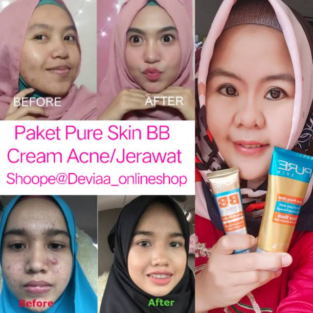 PURE SKIN BB CREAM acne Face Wash my way Sabun kulit wajah Jerawat dan berminyak