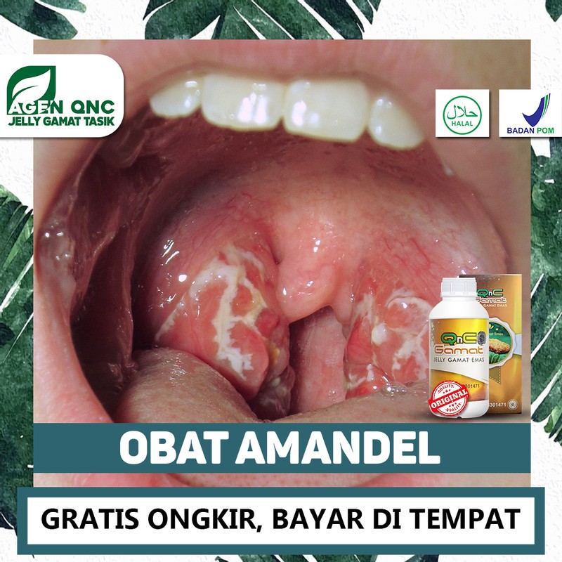 

Obat Amandel Herbal Anak - Amandel Bengkak, Radang Amandel QnC Jelly Gamat Alami Bisa COD