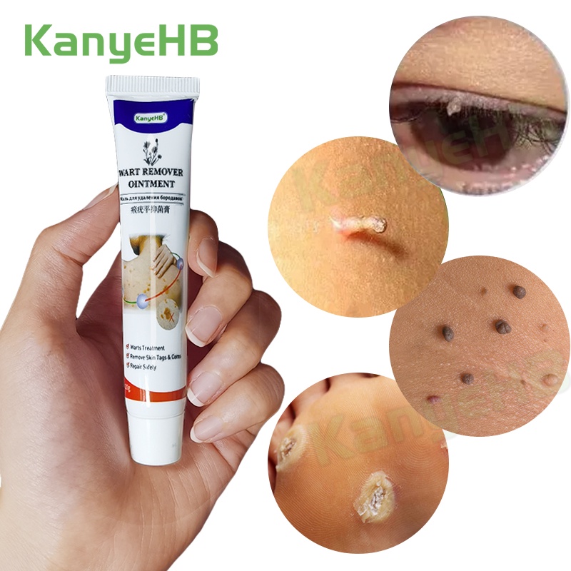 KanyeHB Skin Tag Remover Wart Remover Ointment 20g - Menghilangkan Kutil Tahi Lalat Mata Ikan