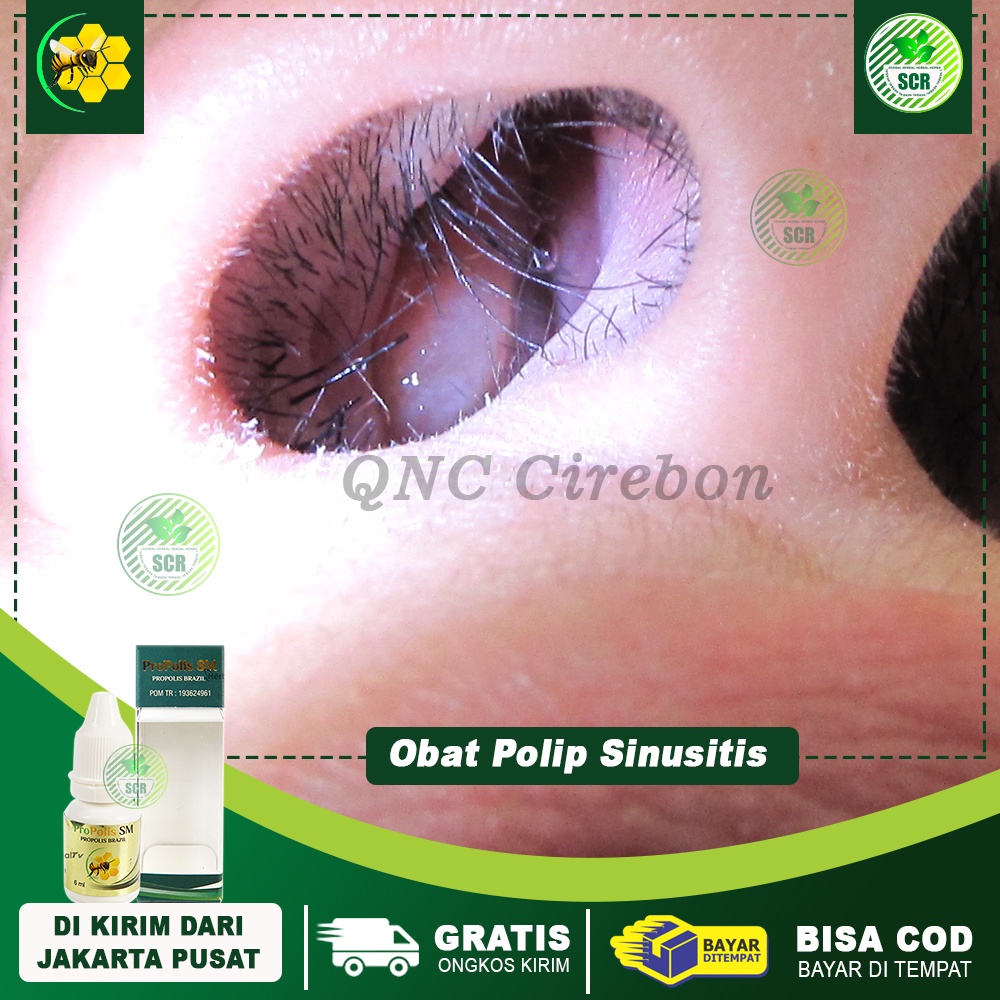 Obat Tetes Hidung Tersumbat, Obat Polip Hidung Herbal - Propolis SM