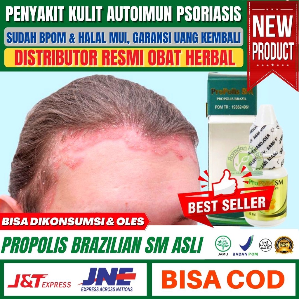 Obat Penyakit Kulit Autoimun Psoriasis Plak Psoriasis Kuku Psoriasis Kulit Kepala Inversi Pustular R