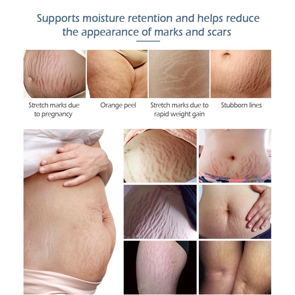 M Pretty Vibrant Krim Penghilang Stretch Mark Untuk Memperbaiki Kulit Shopee Indonesia