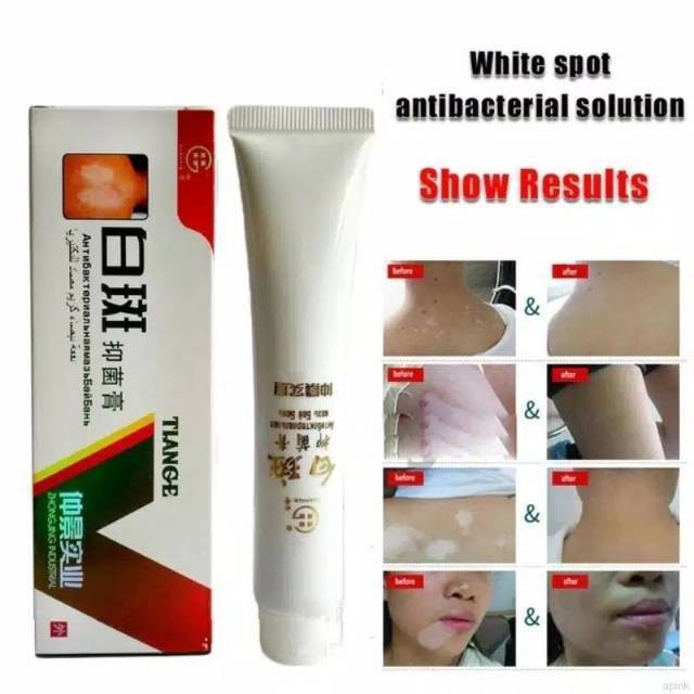 SALEP KULIT SALEP VITILIGO OBAT VITILIGO KORENG BINTIK PUTIH BELANG BERCAK PUTIH PRODUK ORIGINAL