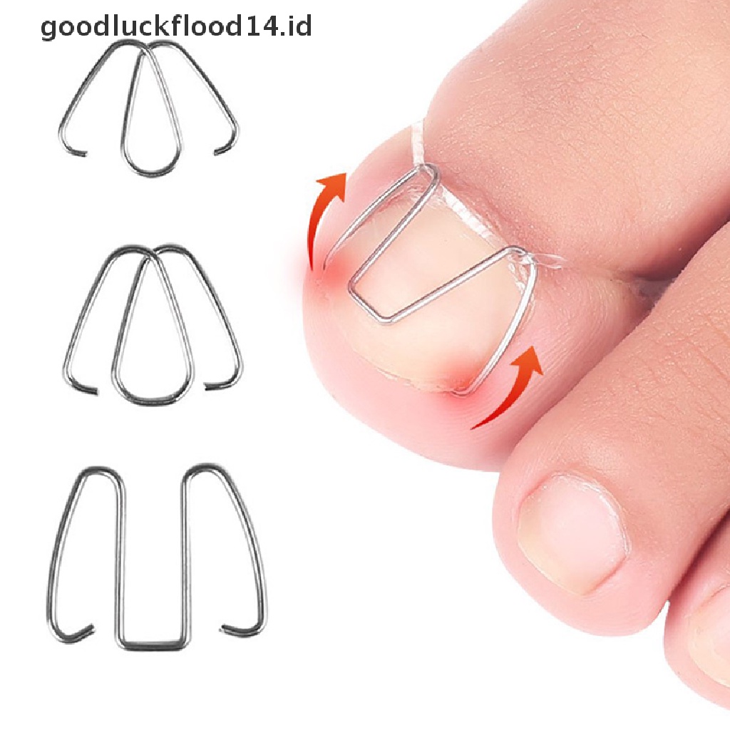 [OOID] Nail Art Ingrown Toe Nail Correction Tool Toenail Nail Orthosis Paronychia Clip ID