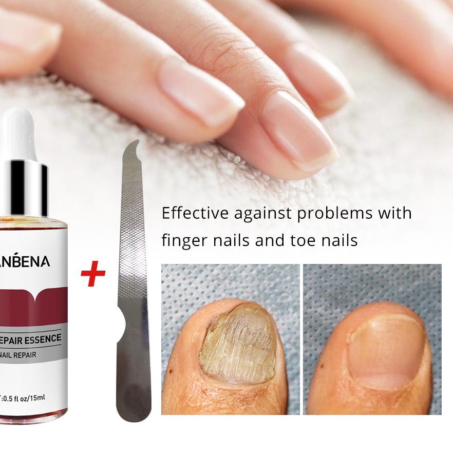 ₹ OBAT KUKU JAMUR DAN RUSAK OBAT KUKU KAKI OBAT JAMUR KUKU KAKI UNTUK PERAWATAN KUKU ゖ゚