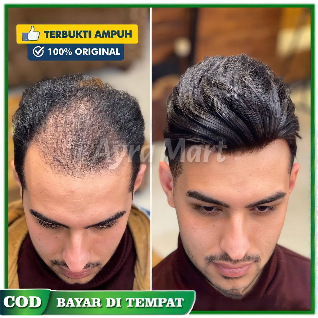 Penumbuh rambut botak depan Penumbuh rambut botak pria mencegah kerontokan rambut Keraniq obat penum