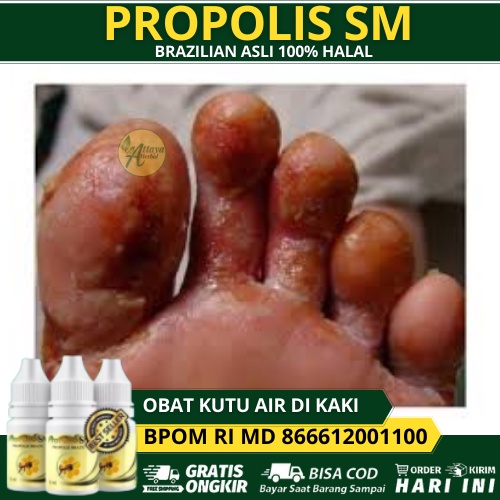 Obat Kutu Air Di Kaki, Telapak Kaki, Di Sela Sela Jari Kaki, Salep Untuk Kutu Air, Penghilang Gatal 