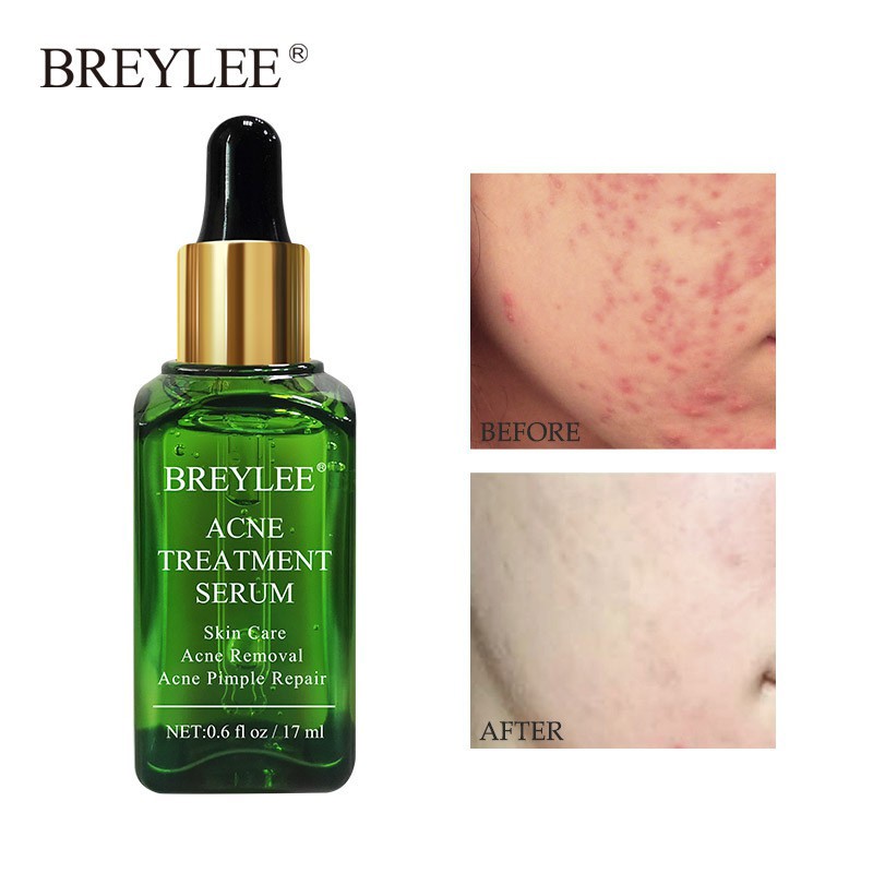 [BPOM] BREYLEE Acne Treatment Serum Skincare- Wajah Penghilang Bekas Jerawat 17ml