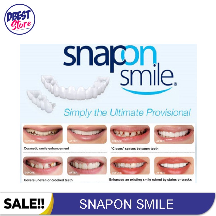 [ BAYAR TEMPAT ] ORIGINAL 100% SNAP ON SMILE SEPASANG GIGI PALSU ATAS BAWAH LEPAS PASANG