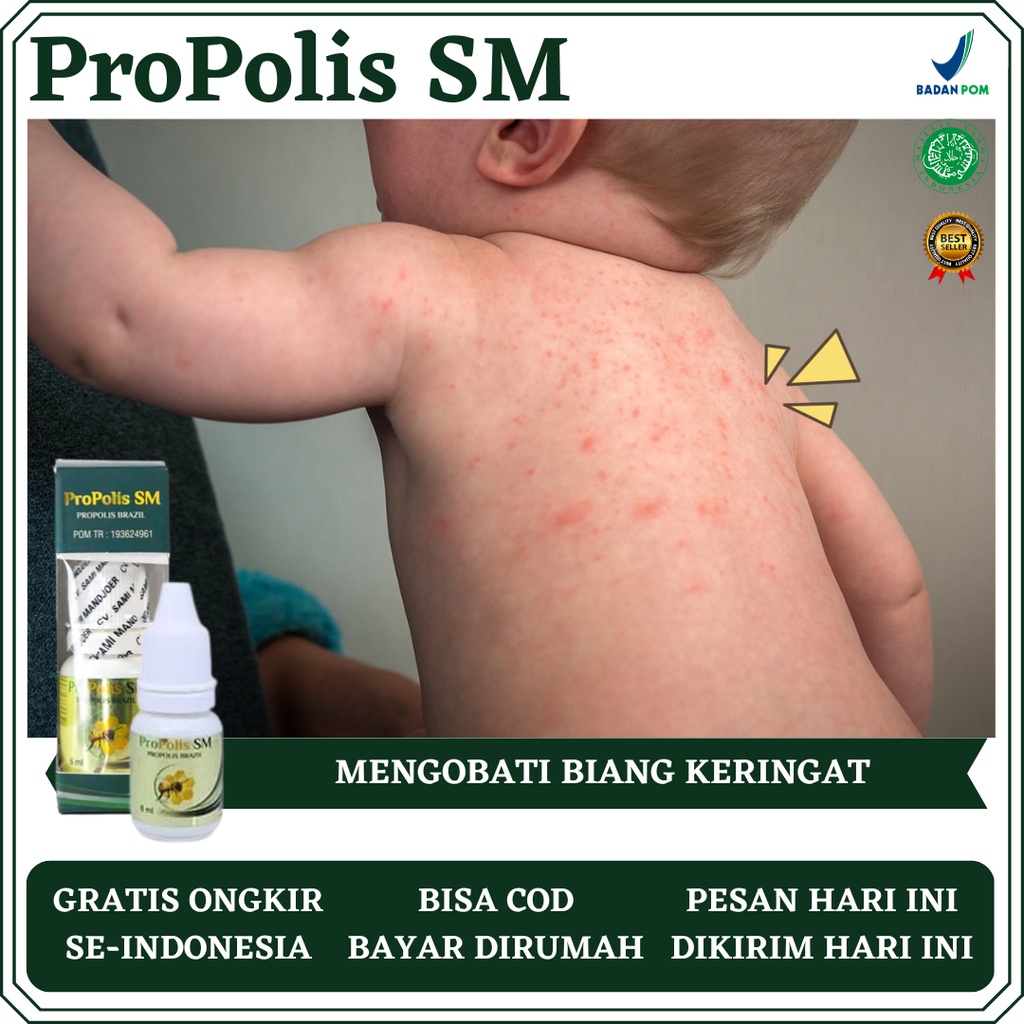 Obat Biang Keringat, Obat Biang Keringat dan Beruntusan, Obat Biang Keringat di Leher Bayi, Obat Bia