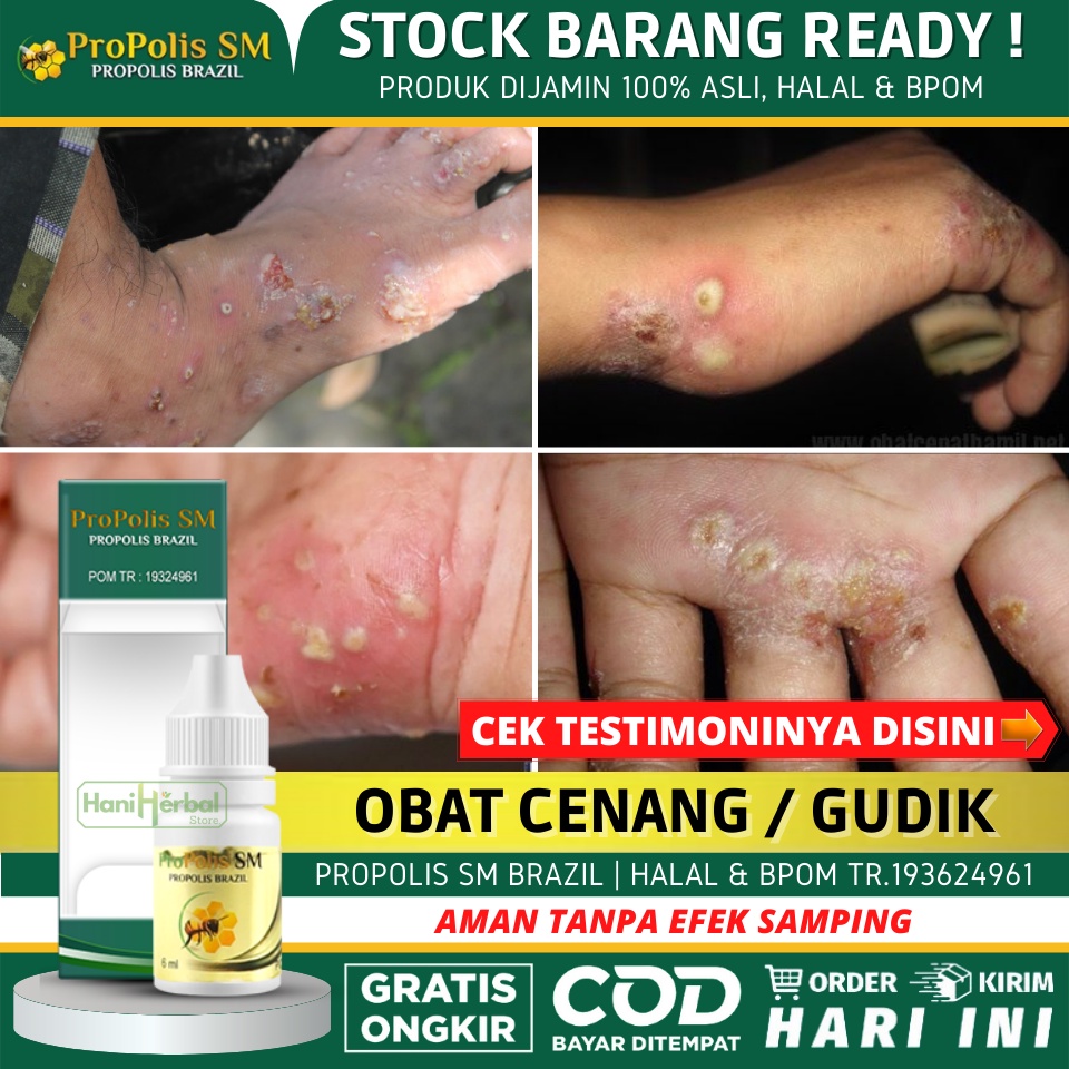 Obat Cenang, Obat Cenang Bernanah, Obat Budug, Obat Gudik, Skabies, Kudis, Scabies Manusia, Campak, 