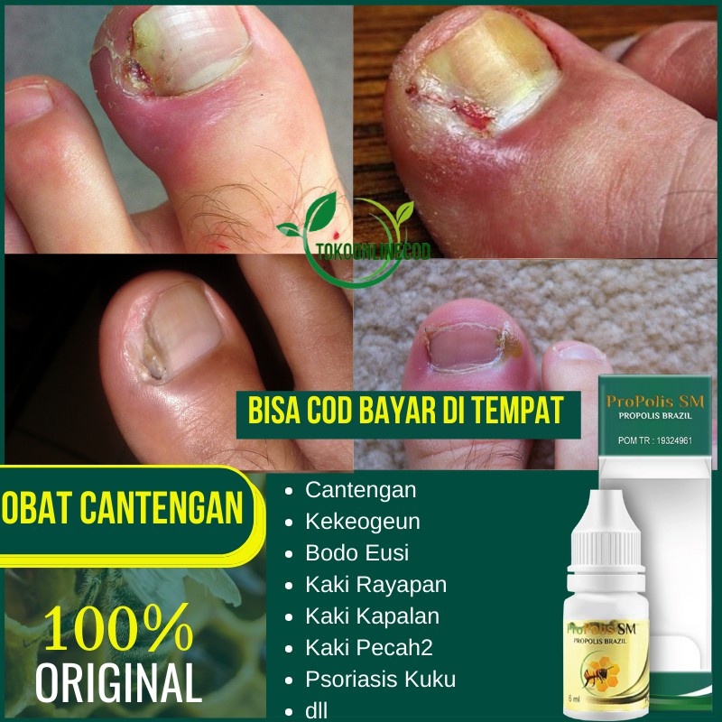 Obat Cantengan Jempol Kaki - Cantengan Kuku - Cantengan Parah - Kekeongeun - Bodo Eusi - Propolis Sm
