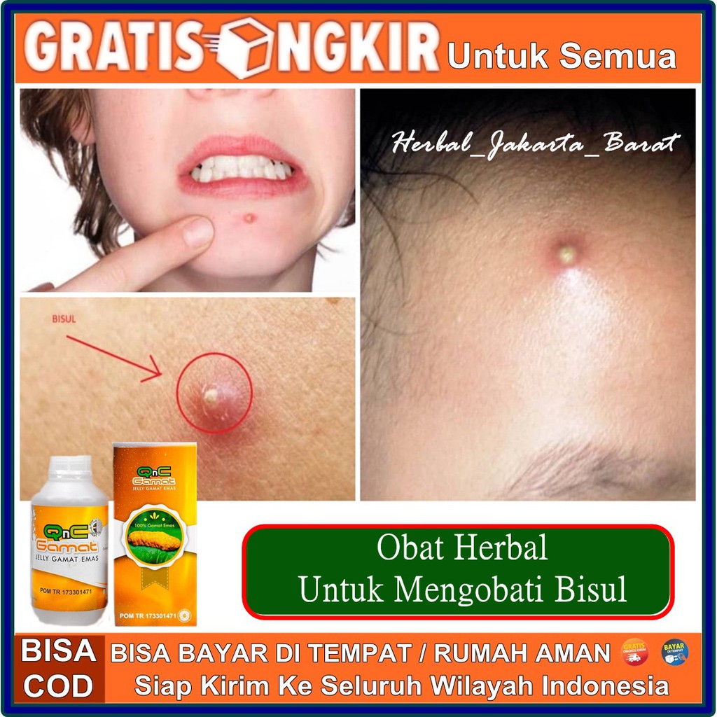 Jual Qnc Obat Bisul Besar Tanpa Nanah Bisul Sudah Pecah Tapi Masih Bengkak Bisul Tidak Punya Mata Indonesia Shopee Indonesia