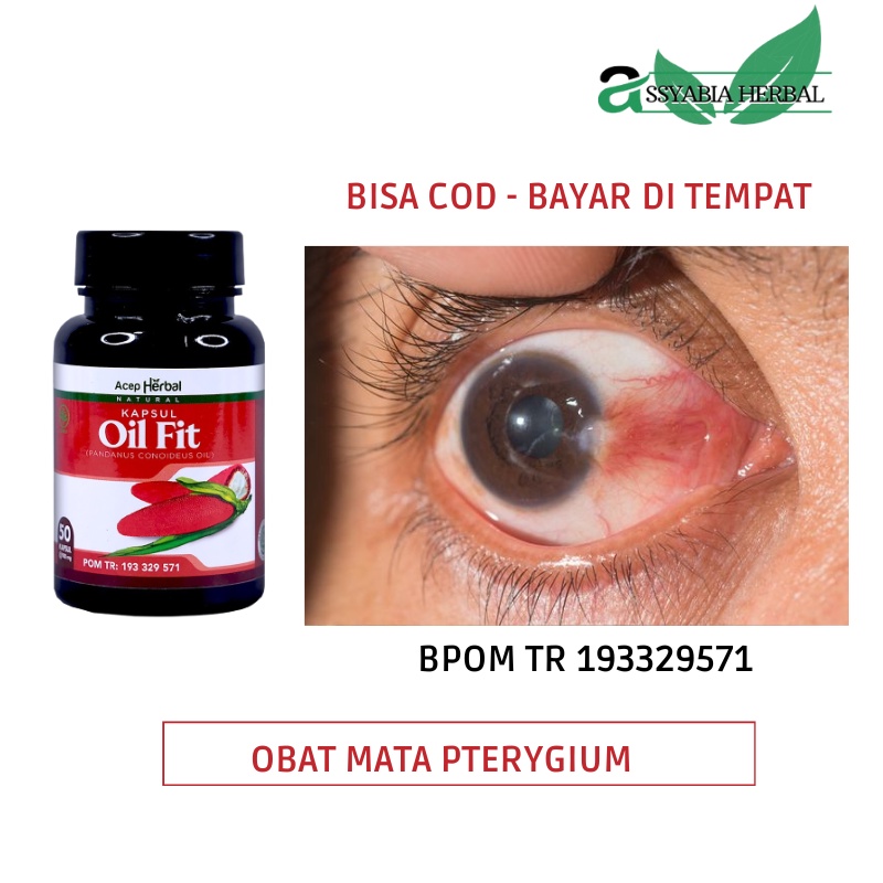 Obat Mata Pterygium, Mata Berlemak, Pterigium, Mata Minus, Penghilang Lemak Mata, Pembersih Mata Kun