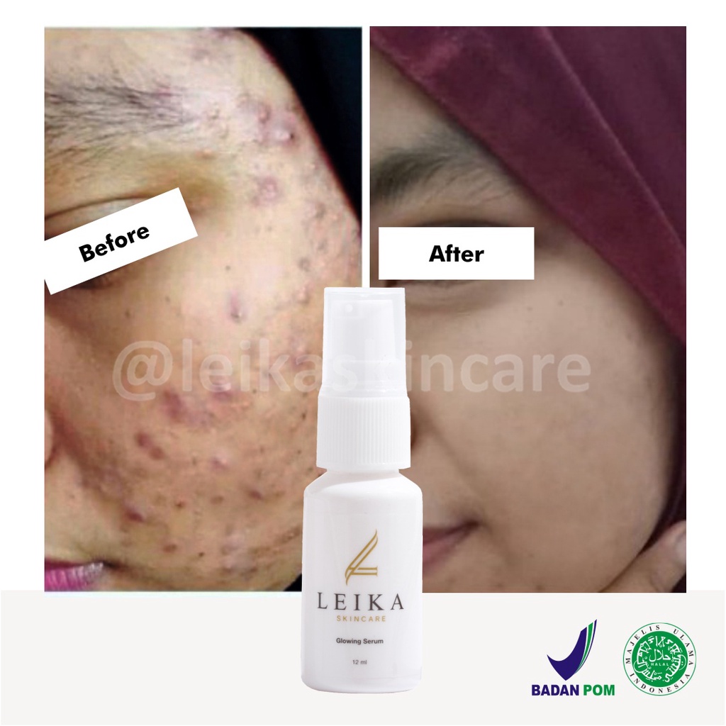 Perawatan Wajah Jerawat Ampuh Penghilang Jerawat dan Bekas Jerawat Halal Serum Jerawat Serum Bopeng