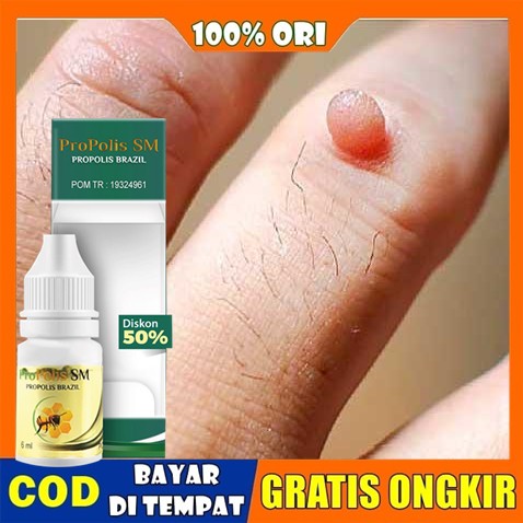 Obat Papiloma Dan Kutil, Obat Papiloma Parasit, Obat Papiloma Kelamin,  Papiloma di Ketiak, di Tubuh