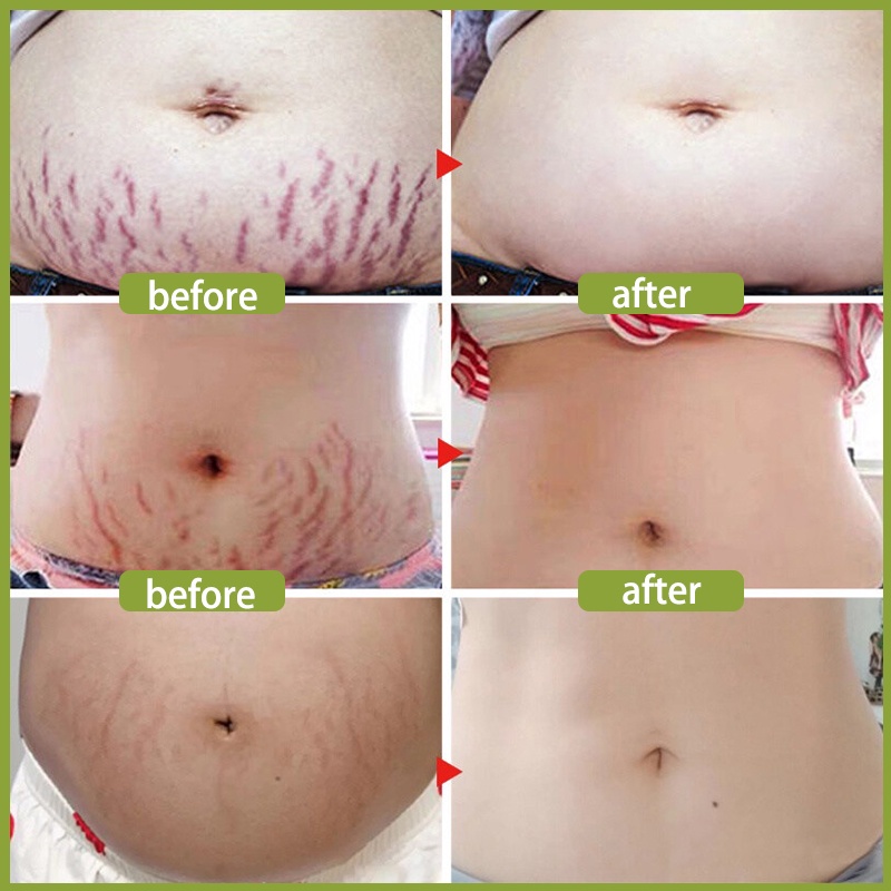 Krim Kehamilan StretchMark Cream krim bekas luka 30ml Pengencang Kulit Solusi Perut Gatal dan Anti Stretchmark Ibu Hamil Stretch Mark Krim Penghilang Stretch Mark mama choice stretch mark stretch mark