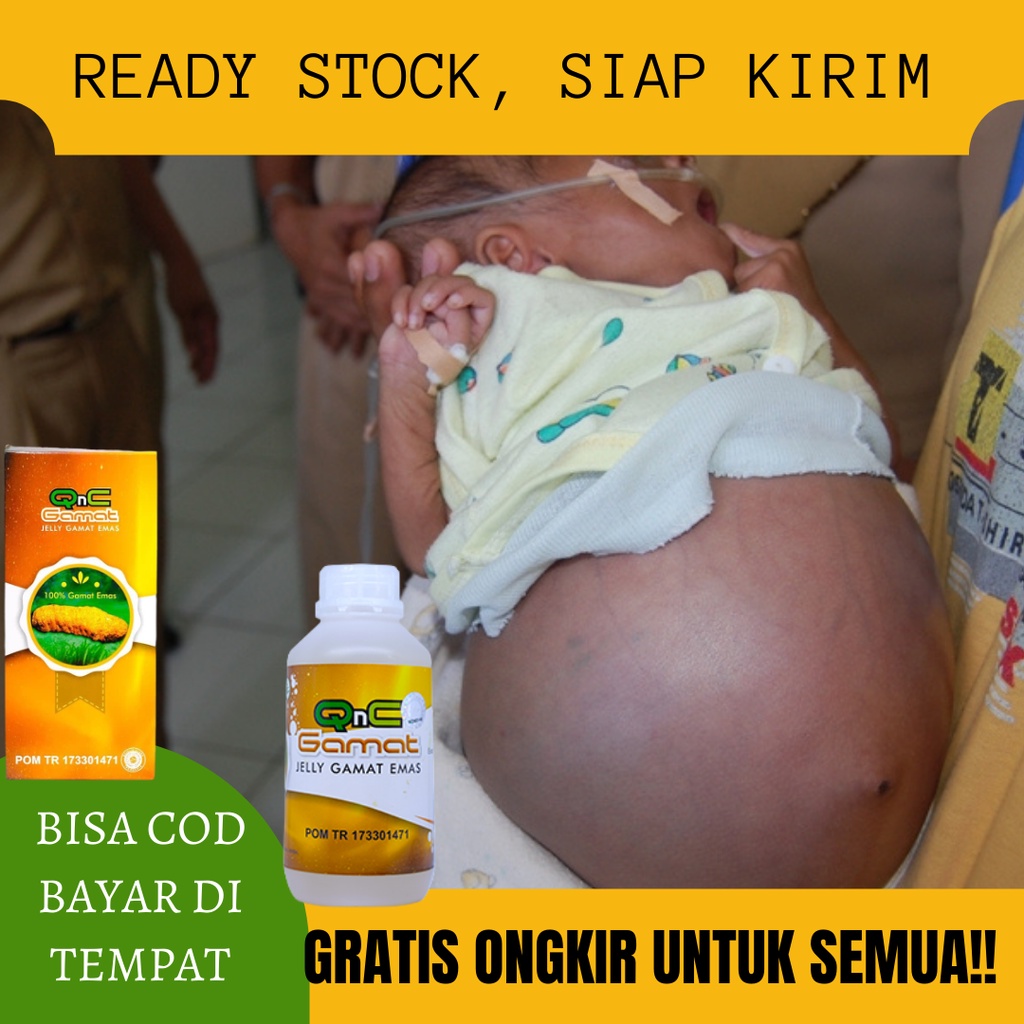 Obat Khusus Hisprung, Hisprung Pada Bayi, Balita, Dewasa dan Lansia, Perut Kembung, Perut Bengkak, O