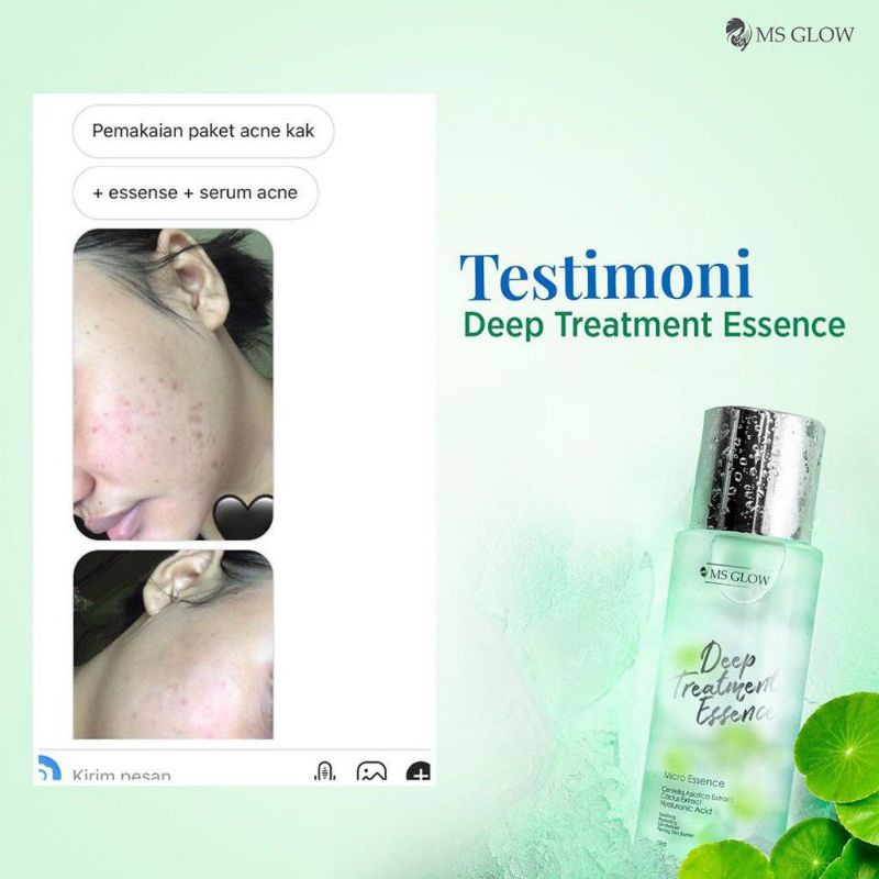 MS Glow Deep Treatment ESSENCE/ MS Glow Deep ESSENCE Treatment Original Penghilang Jerawat Permanen