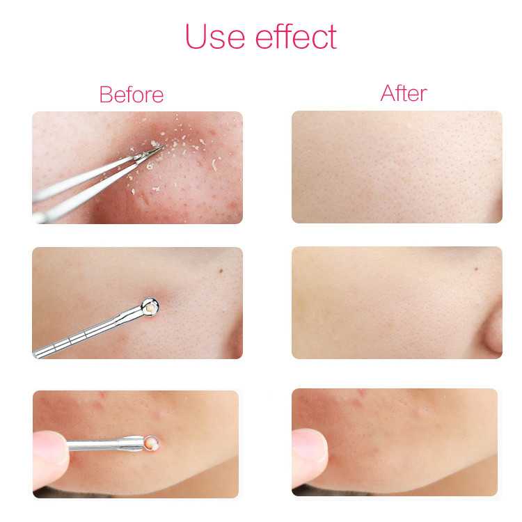 Alat Pembersih Komedo Jerawat Wajah Pinset Komedo Acne Removal Stainless Steel