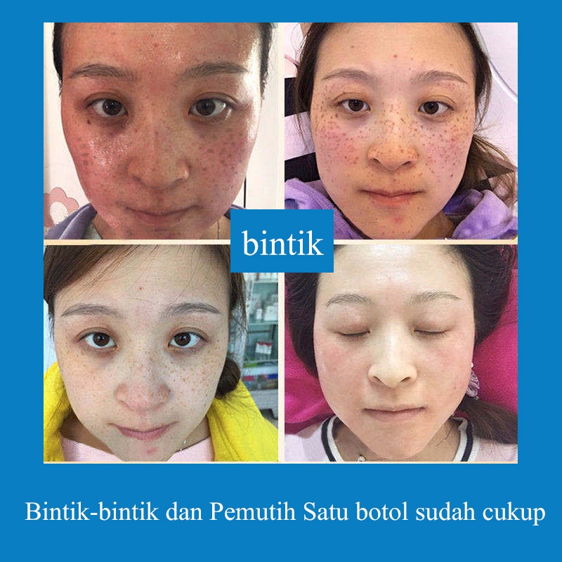 Hight whitening salep flek hitam 30g penghilang flek hitam di wajah white neng cream flek hitam krim bintik Perbaikan bekas luka dan bintik-bintik secara permanen dan efektif