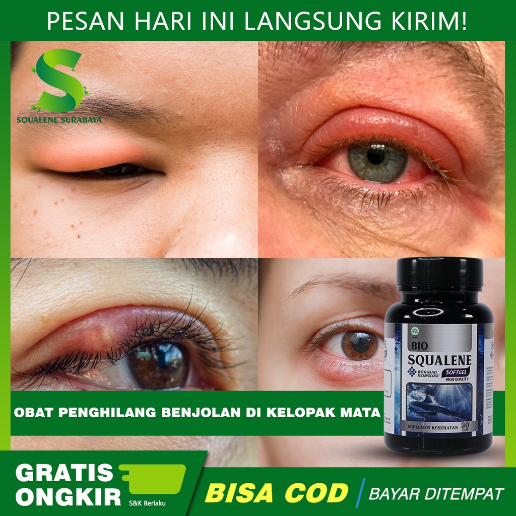 Jual Obat Penghilang Benjolan Di Kelopak Mata - Mata Bintitan Bagian ...