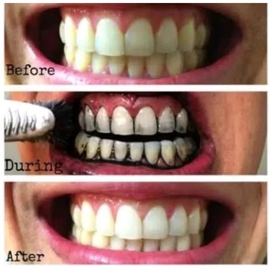 Charcoal Activated Powder Teeth Whitening Arang . Pemutih Bleaching Gigi Pouch