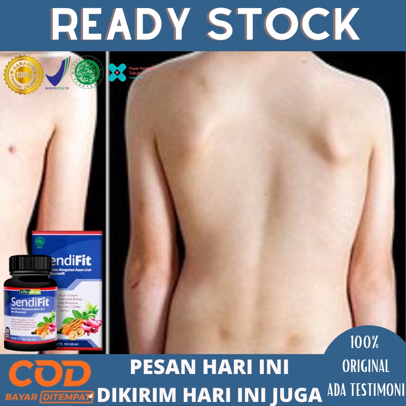 Obat skoliosis tulang bengkok, Obat skoliosis herbal, Obat tulang punggung bungkuk, Obat skoliosis, 