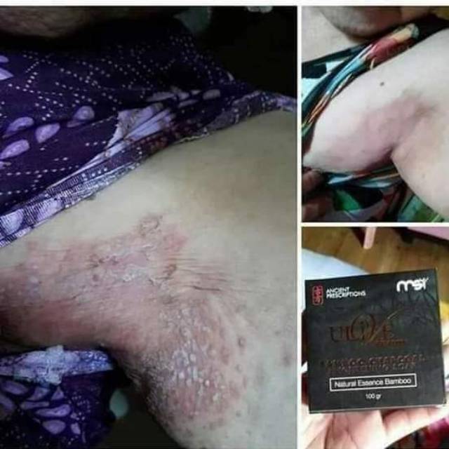 Sabun Bamboo MSI ampuh Atasi Gatal Gatal