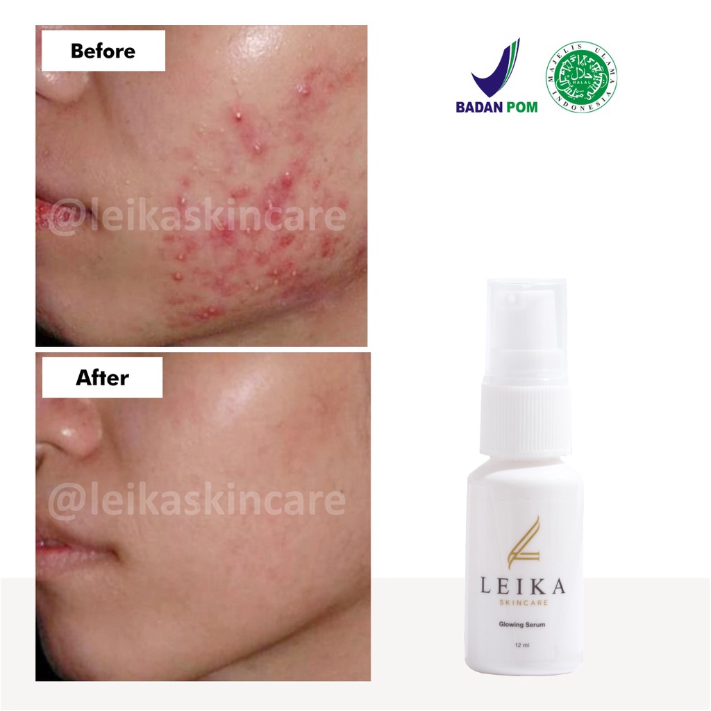 Serum Penghilang Jerawat Batu Radang Ampuh Serum Jerawat Meradang Penghilang Bekas Jerawat Meradang Obat Jerawat Batu Meradang Asli HALAL MUI Glowing Serum Leika Skincare Resmi BPOM