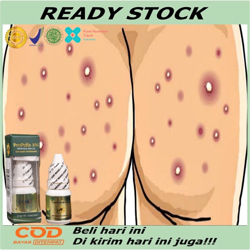 Obat pantat gatal - Obat bisul di pantat - Obat Pantat burik - Obat pantat hitam - Obat pantat brunt