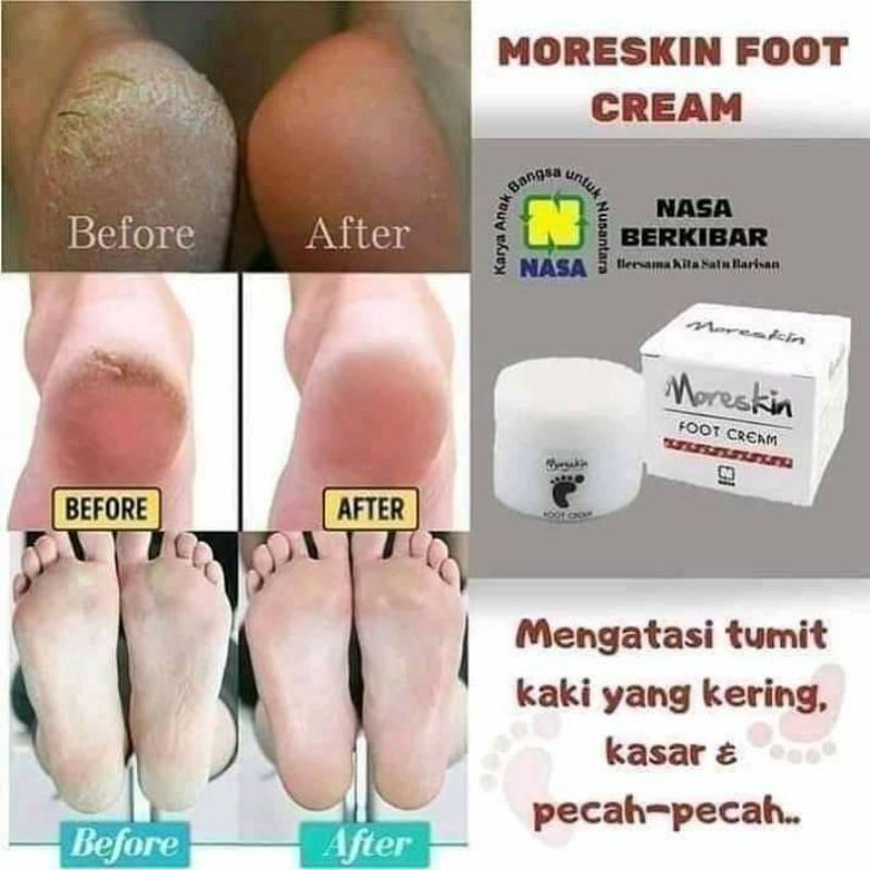 crem kaki ampuh atasi kaki pecah2 dan kering
