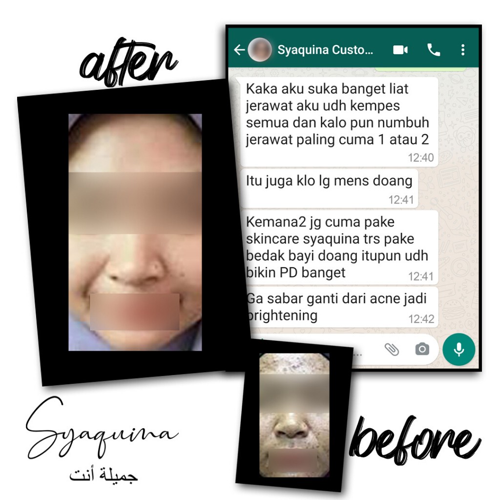 Syaquina Expert Paket Acne Series / Skincare Kulit Jerawat & Berminyak / Formulasi Dokter BPOM & MUI-2