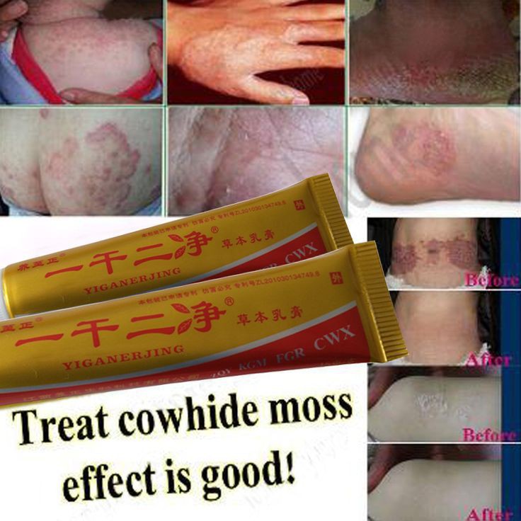 READY ORI Krim Salep Yiganerjing Herbal Anti Bakteri Eksim Gatel Psoriasis Efektif untuk Kesehatan-3