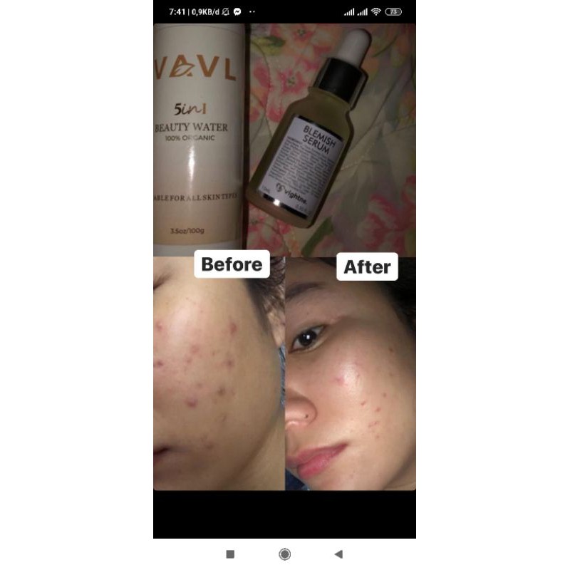 VAVL SERUM BLEMISH SERUM free gift