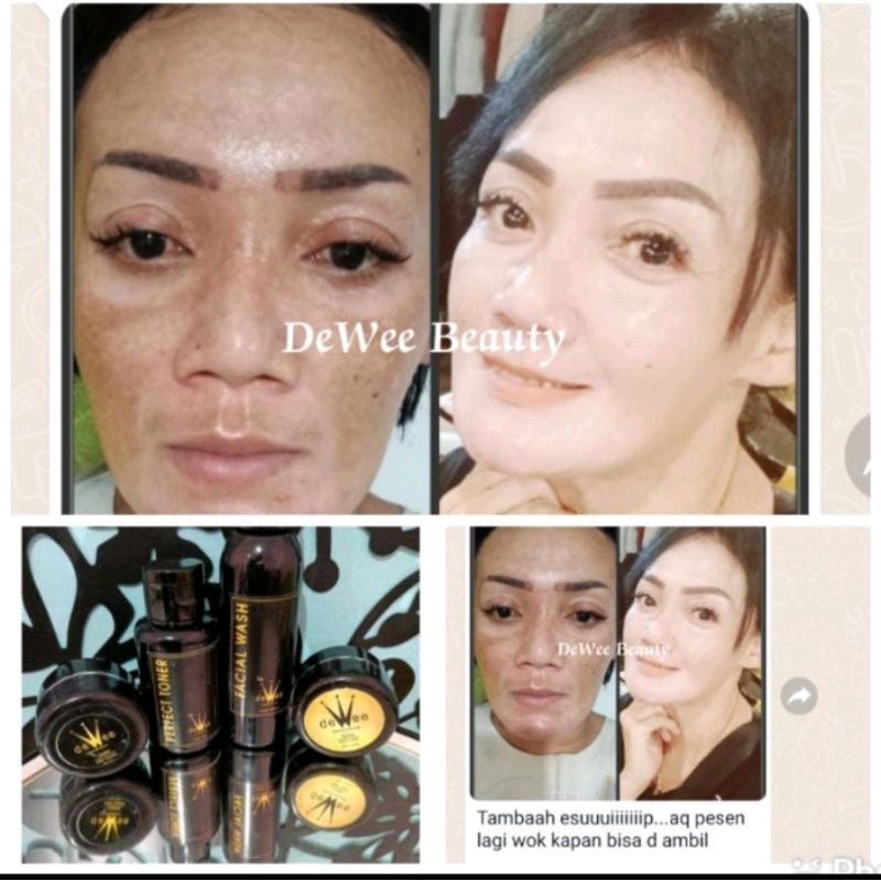 100 X Cepat 5 hari Jaminan Glowing ( BPOM ) COD FLEK PARAH JERAWAT PARAH BOPENG BRUNTUSAN FLEK MENAH