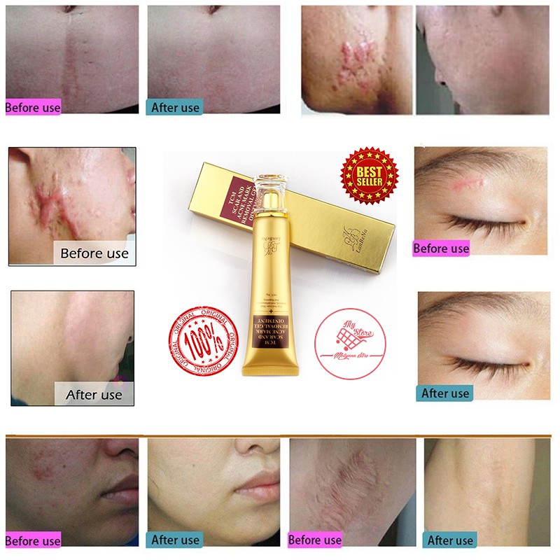 Penghilang Bekas Luka TCM LANBENA Scar and Acne Mark Removal Gel Ointment